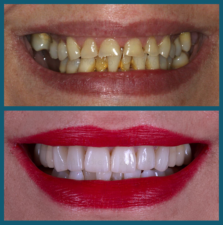tratamiento de implantes y carillas en clínica orgaz dental usera