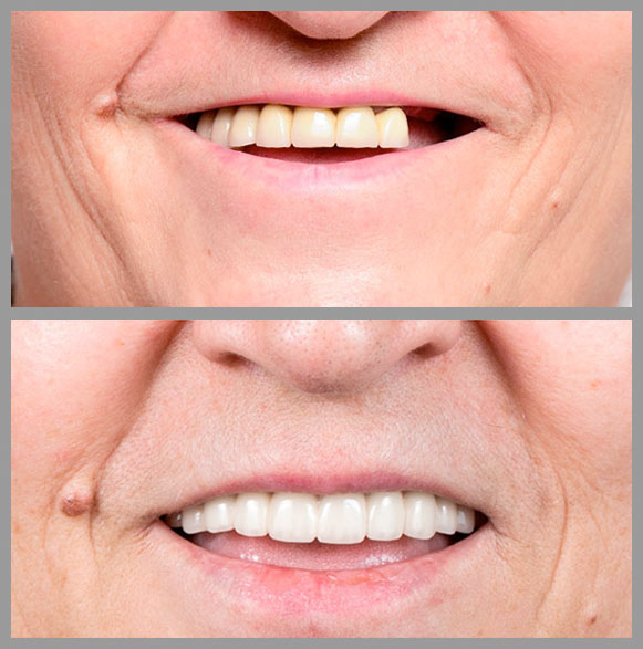 implantes carga inmediata clínica orgaz dental usera