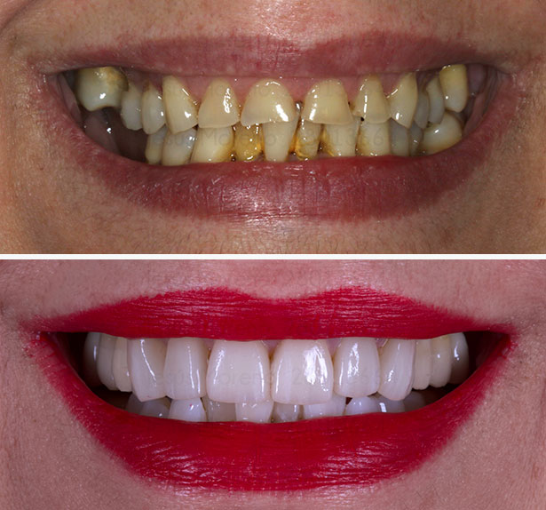 Tratamiento mixto de implantes con carillas para mejorar la estética dental