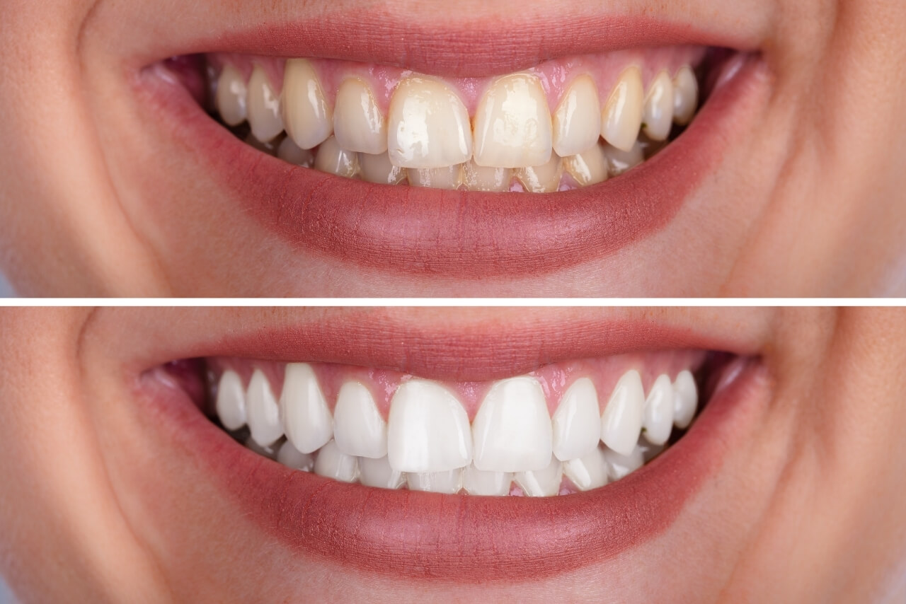 Colores de los Dientes y el Esmalte Dental: Por Qué Cambian y Cómo Recuperar el Color Natural