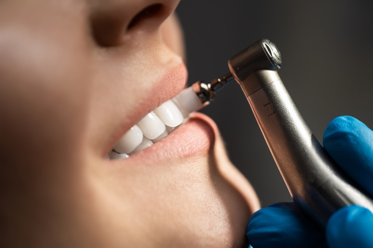 Limpieza Dental Profesional: La Clave para una Sonrisa Sana y Brillante Todo el Año