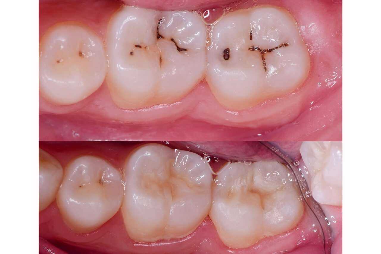 Caries Dentales: Qué Son, Por Qué Aparecen y Cómo Prevenirlas
