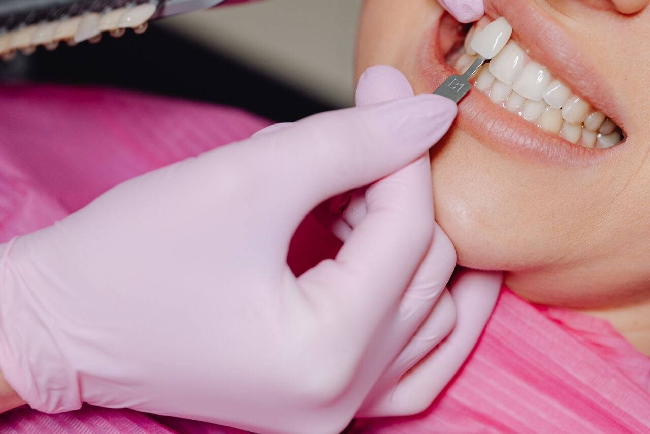 Carillas Dentales: El Secreto Mejor Guardado de las Sonrisas Perfectas
