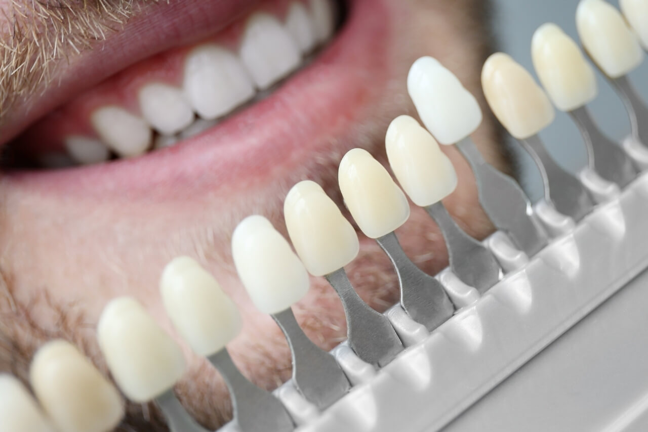 Carillas Dentales: El Secreto Mejor Guardado de las Sonrisas Perfectas