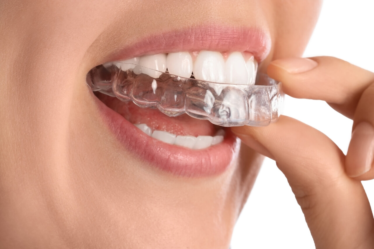 Férulas de Descarga: La Solución Invisible al Dolor Mandibular y al Estrés Dental