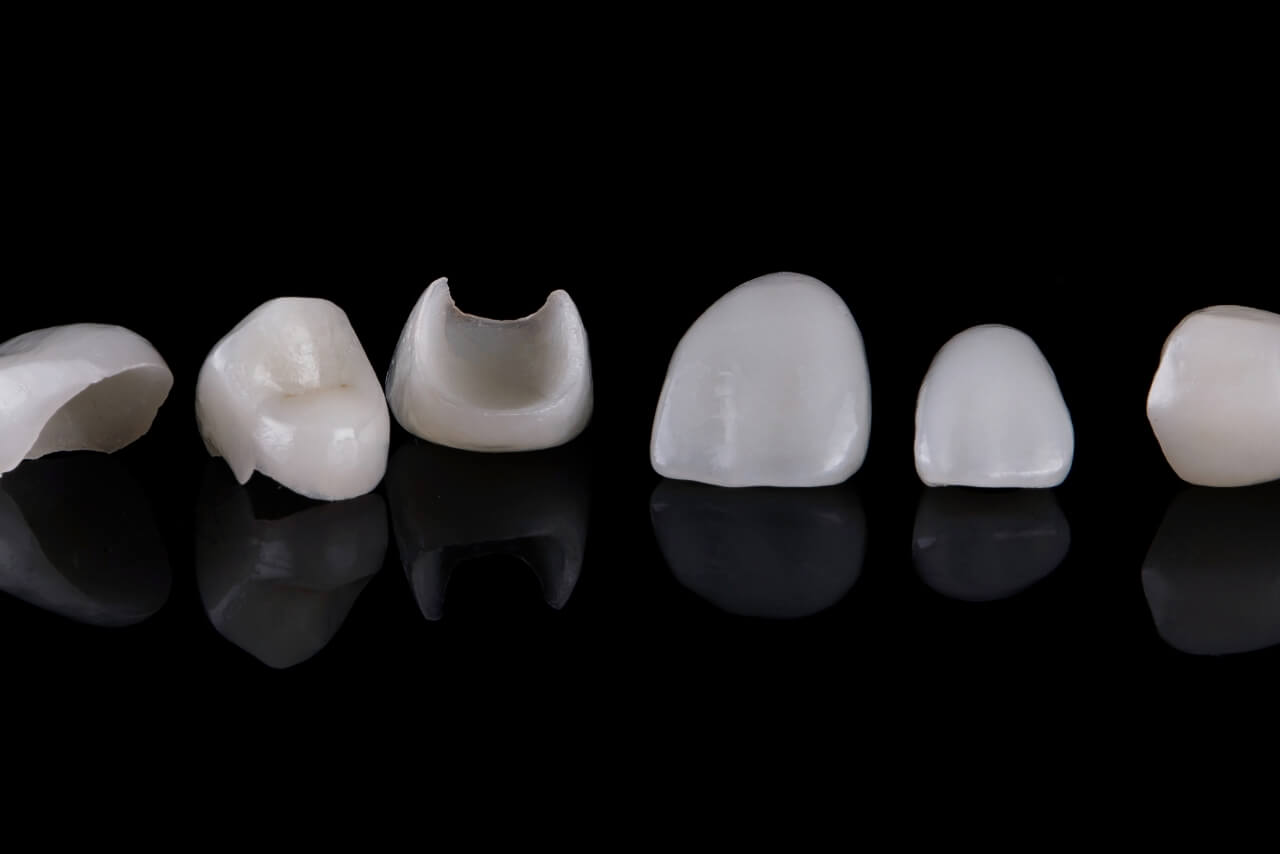 Carillas Dentales: El Secreto Mejor Guardado de las Sonrisas Perfectas