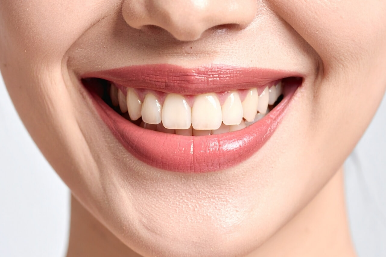 Carillas Dentales: El Secreto Mejor Guardado de las Sonrisas Perfectas