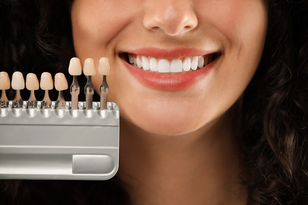 Carillas Dentales: Cuándo Están Indicadas, Qué Tipos Existen y Cómo Mantener una Sonrisa Perfecta