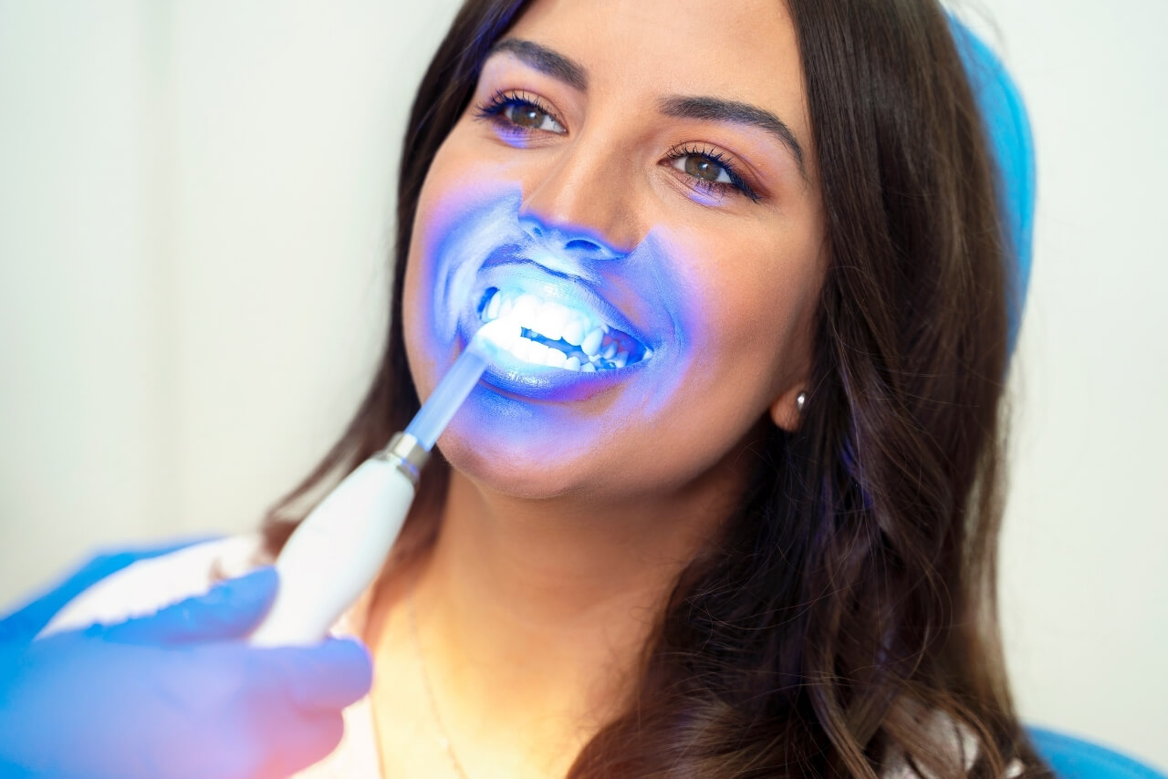 Blanqueamiento Dental Profesional: Lo Que Nadie Te Cuenta Antes de Hacerlo