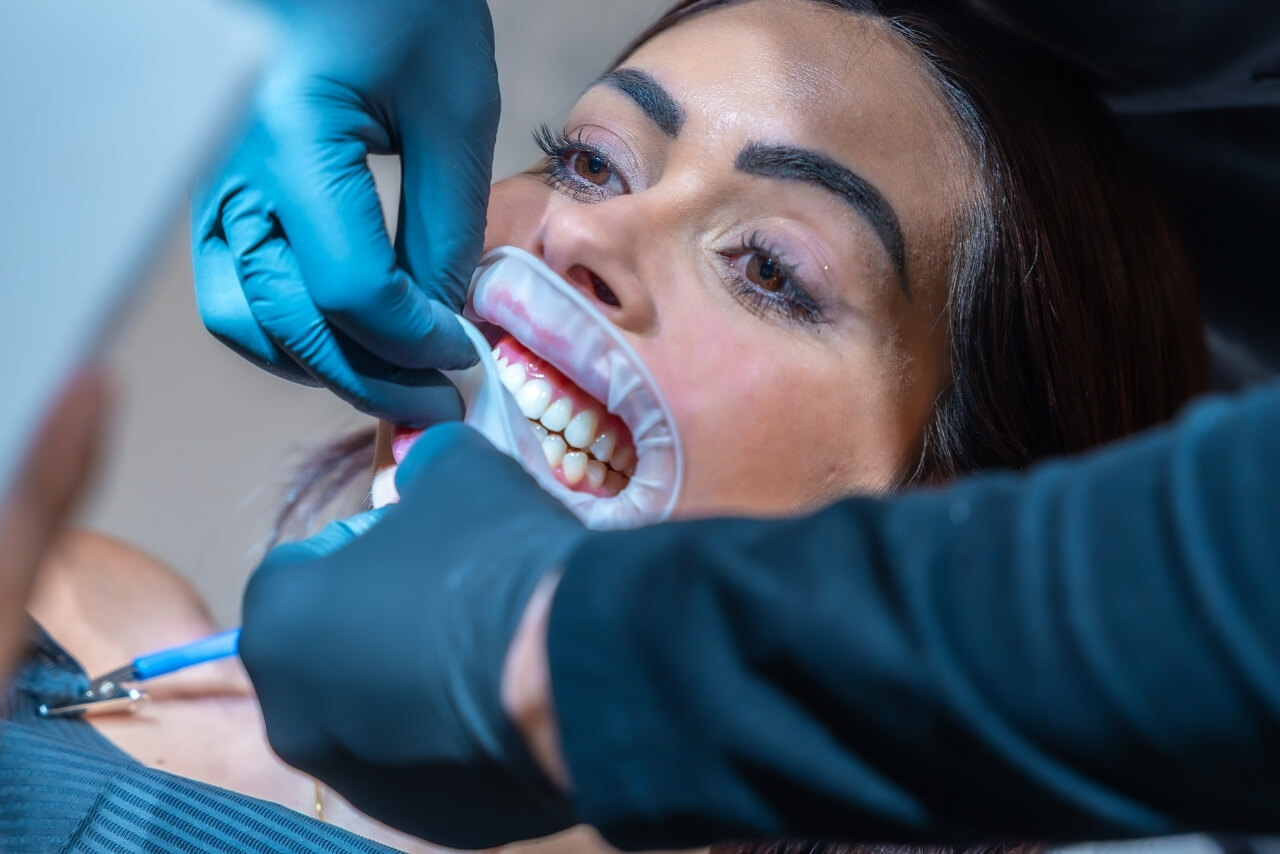 Blanqueamiento Dental Profesional: Lo Que Nadie Te Cuenta Antes de Hacerlo