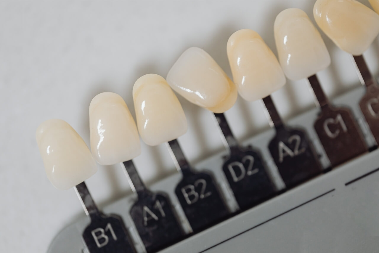 Carillas Dentales: Cuándo Están Indicadas, Qué Tipos Existen y Cómo Mantener una Sonrisa Perfecta
