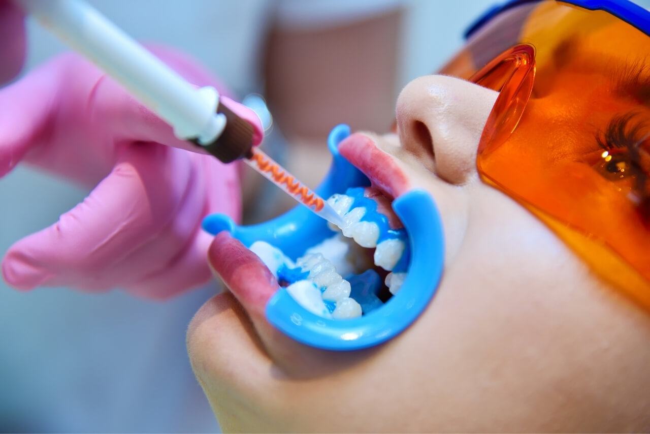 Blanqueamiento Dental Profesional: Lo Que Nadie Te Cuenta Antes de Hacerlo