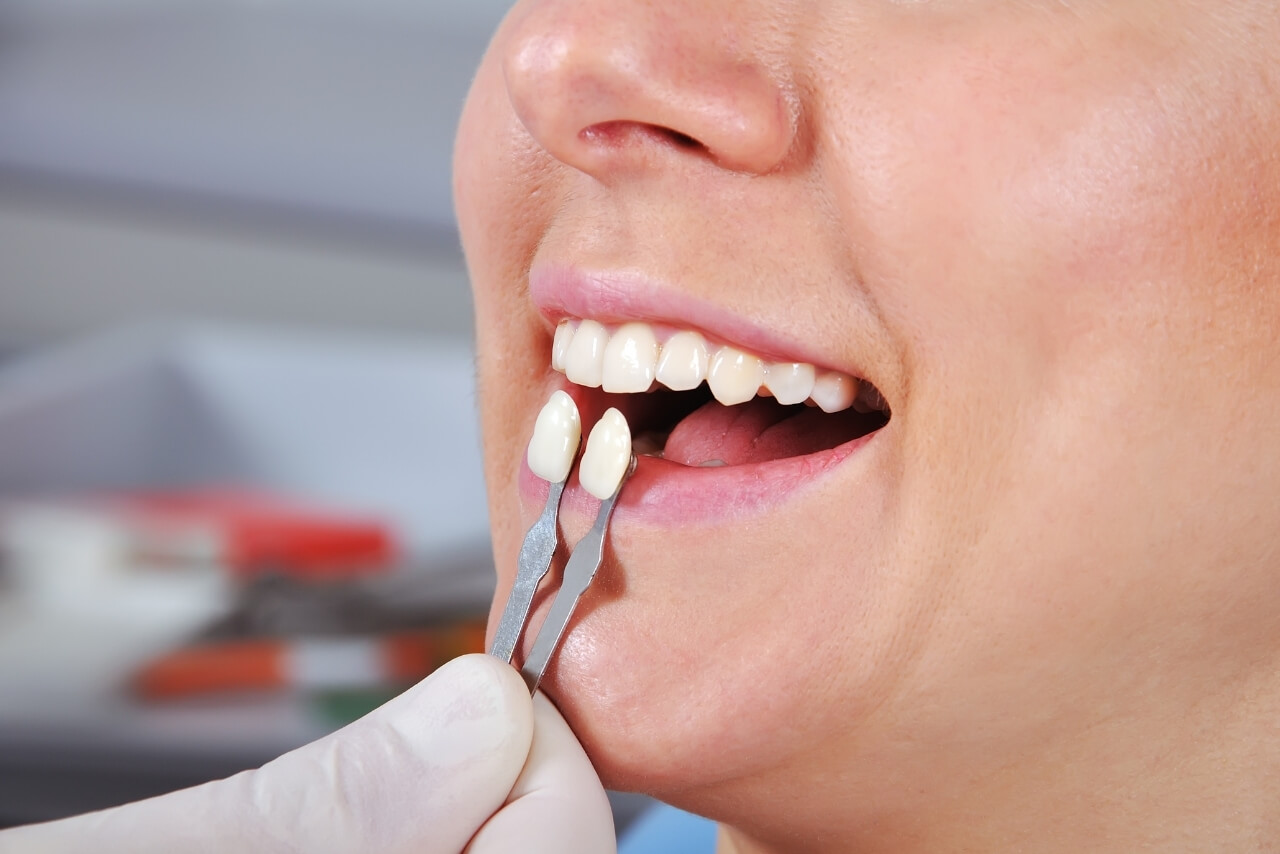 Carillas Dentales: Cuándo Están Indicadas, Qué Tipos Existen y Cómo Mantener una Sonrisa Perfecta