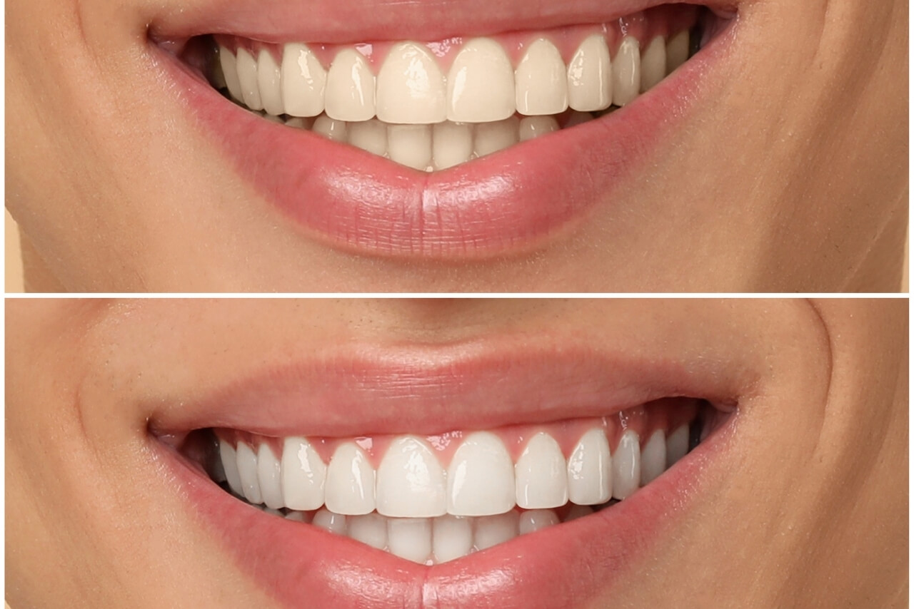 Todo lo que Debes Saber para Conseguir una Sonrisa Más Blanca de Forma Segura