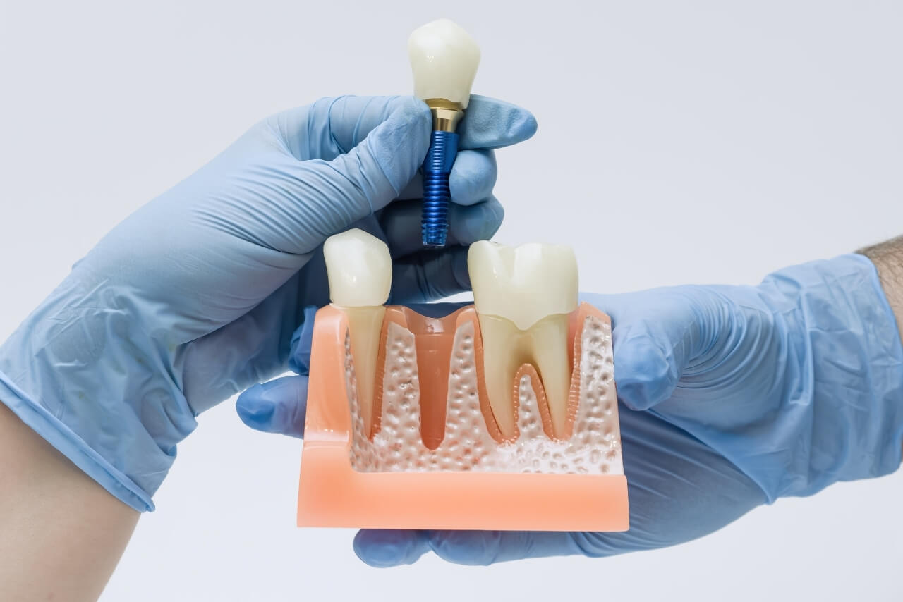 Implantes Dentales: Proceso, Beneficios, Duración y Cuidados para Recuperar Dientes Perdidos