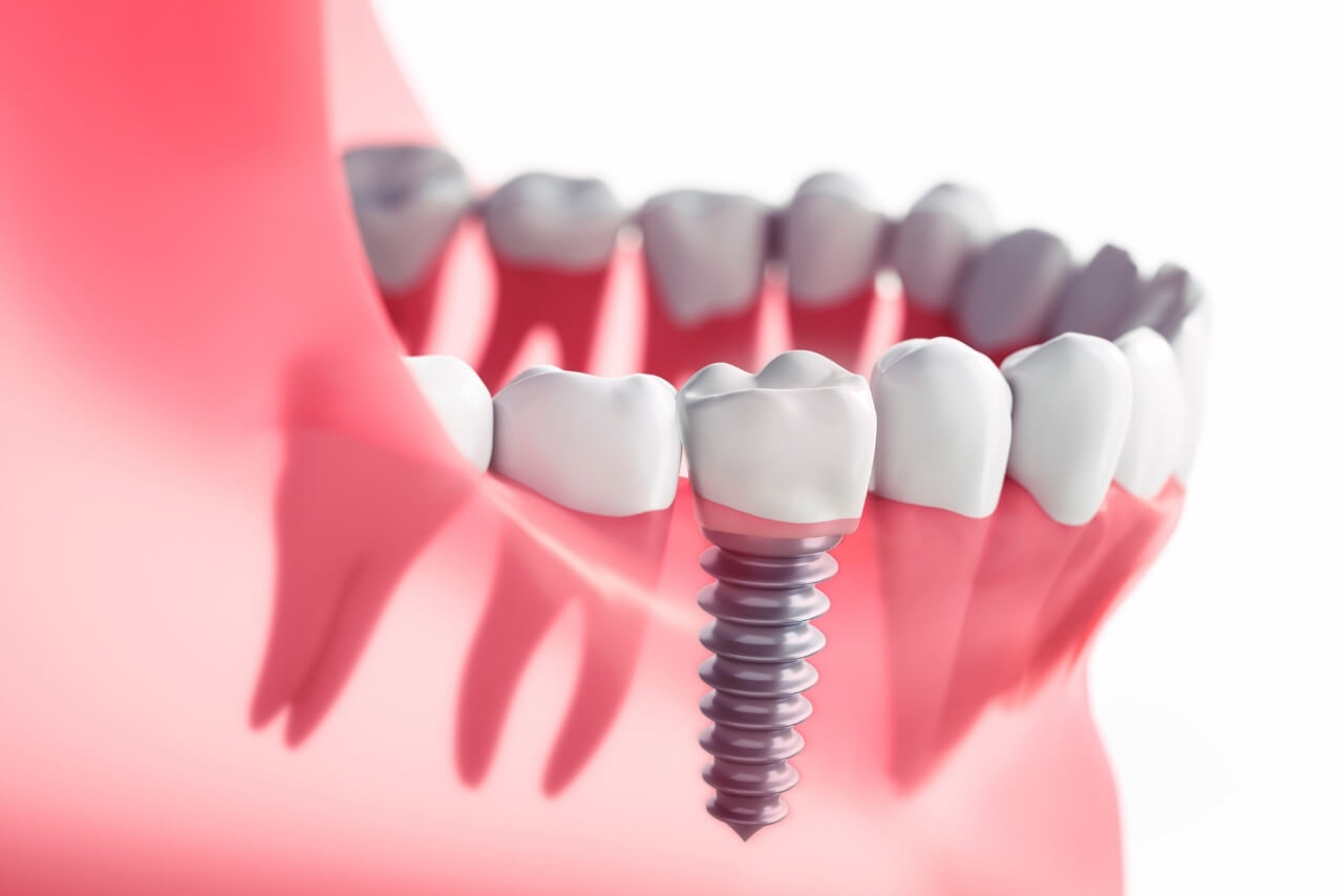Implantes Dentales: Proceso, Beneficios, Duración y Cuidados para Recuperar Dientes Perdidos