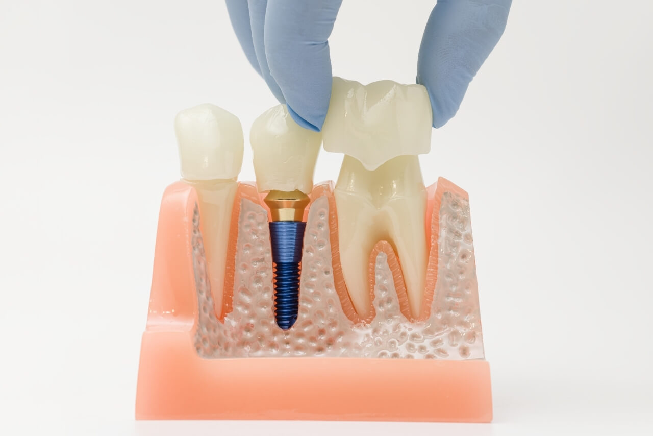 Implantes Dentales: Proceso, Beneficios, Duración y Cuidados para Recuperar Dientes Perdidos
