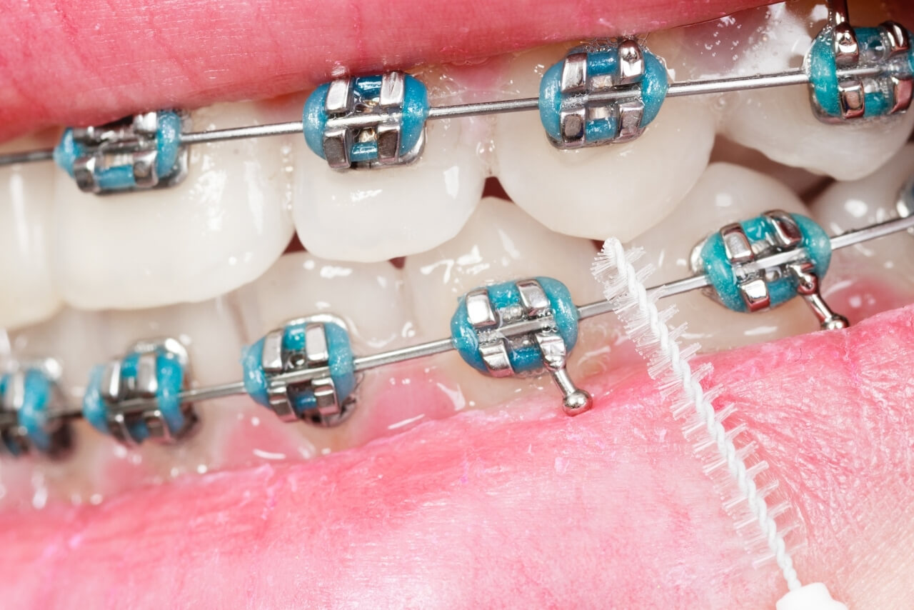 Higiene Bucal Durante la Ortodoncia: Cómo Cuidar tus Dientes y Encías Durante el Tratamiento
