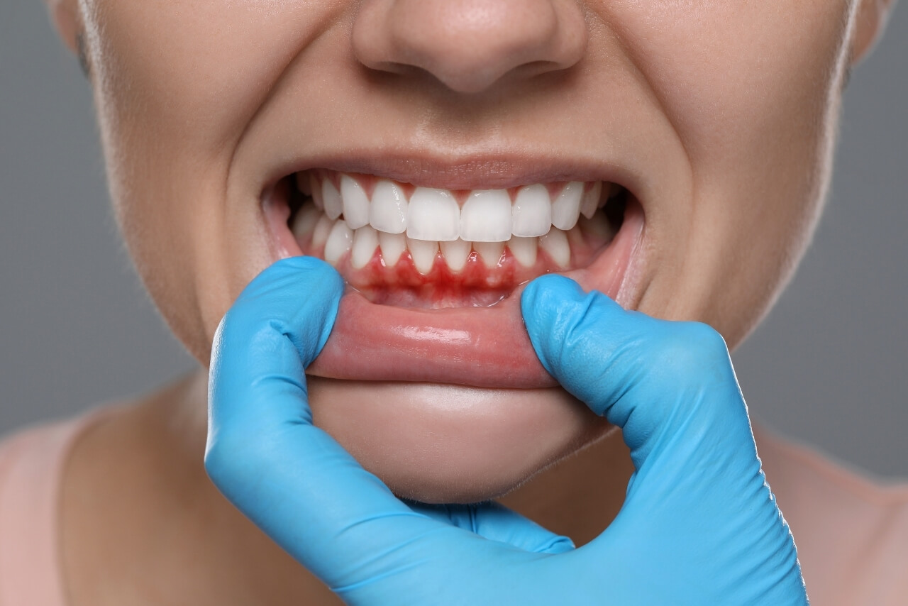 Cómo Prevenir la Periodontitis y Mantener unas Encías Sanas