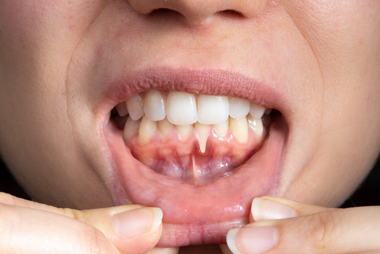 Cómo Prevenir la Periodontitis y Mantener unas Encías Sanas