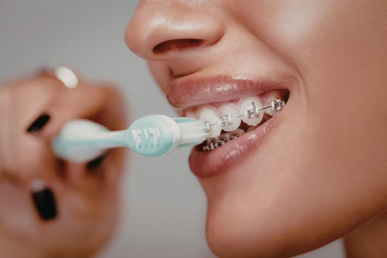 Higiene Bucal Durante la Ortodoncia: Cómo Cuidar tus Dientes y Encías Durante el Tratamiento
