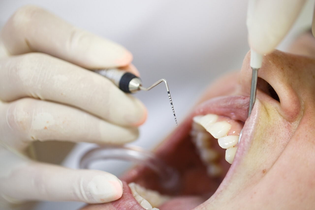 Cómo Prevenir la Periodontitis y Mantener unas Encías Sanas